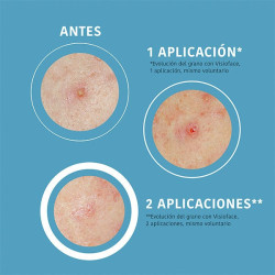 Sos Pimple Patches