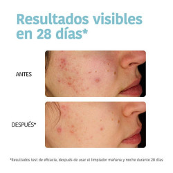 Purifying Anti-Blemish