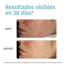 Exfoliating Anti-Blemish