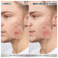 8 Hours Pimple Patch