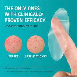 XL Pimple Patches