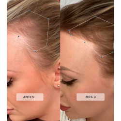 Vitaminas Crecimiento Del Cabello